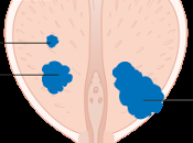 #thelancet #cancerdelaprostate #IRMmultiparamétrique #biopsietransrectale Précision diagnostique d’une multiparamétrique biopsie transcrectale ultrasons dans cancer prostate (PROMIS) étude confirmatoire validation paires