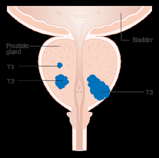 #thelancet #cancerdelaprostate #IRMmultiparamétrique #biopsietransrectale Précision diagnostique d’une IRM multiparamétrique et d’une biopsie transcrectale par ultrasons dans le cancer de la prostate (PROMIS) : étude confirmatoire de validation par paires