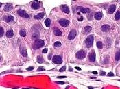 #thelancetoncology #cancerurothelial #PD-L1 #nivolumab Nivolumab pour traitement carcinome urothélial métastatique après thérapie base platine (CheckMate 275) étude multicentrique phase simple bras