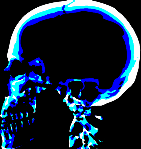 blu1-skull-x-ray