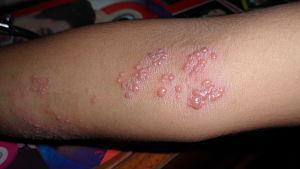 obat herpes