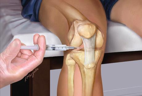 ACIDE HYALURONIQUE: Principe d’action des injections intra-articulaires – Santé Orthopédique