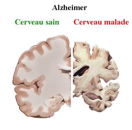 Avantages du Curcuma contre la maladie d’Alzheimer