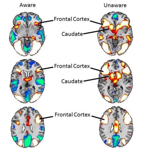 PHOBIES: L'exposition inconsciente aux stimuli, la meilleure des thérapies? – Human Brain Mapping