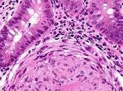 #thelancet #pédiatrie #maladiedecrohn Prédiction d’une complication cours maladie chez enfants atteints Crohn nouvellement diagnostiquée étude multicentrique cohorte initiale