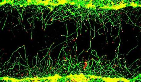 SEP, ALZHEIMER : La molécule qui répare nos axones  – Neuron