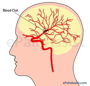 #thelancetneurology #AVC #thrombectomie #alteplase #SolitaireFR Sécurité et efficacité d’une thrombectomie lors d’un accident vasculaire cérébral ischémique aigu (REVASCAT): Une année de suivi d’un essai randomisé ouvert