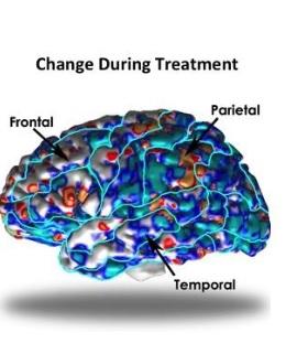 DÉPRESSION : Le cerveau a son propre système de décompression – Molecular Psychiatry