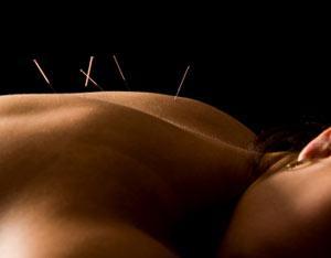 Comment soulager les douleurs lombaires avec l'acupuncture