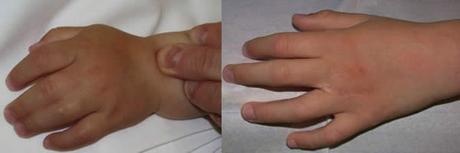 Syndactylie des doigts
