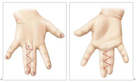 Syndactylie des doigts