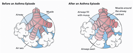 #thelancetrespiratorymedicine #asthme #mepolizumab #corticostéroïdes Efficacité du mepolizumab comme thérapie d’appoint sur la qualité de vie liée à la santé et les marqueurs de contrôle de l’asthme (MUSCA) : un essai de phase 3b multicentrique randomi...