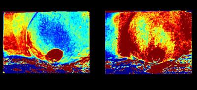 SFDI images of breast tissue damage by radiation therapy