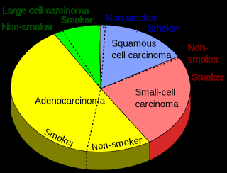 #thelancet #CBNPC #exclusif #alectinib #crizotinib Alectinib versus crizotinib chez des patients atteints de cancer du poumon non à petites cellules ALK-positif (J-ALEX) : essai de phase 3 ouvert, randomisé