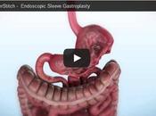 OBÉSITÉ gastroplastie chirurgicale montre efficacité Digestive Disease Week