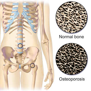 #thelancetdiabetesandendocrinology #ménopause #ostéoporose #denosumab 10 ans de traitement au denosumab chez des femmes post-ménopausées atteintes d’ostéoporose : résultats de l’étude de phase 3 FREEDOM  et de sa prolongation en ouvert
