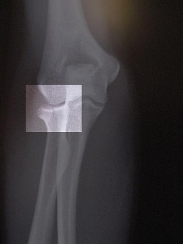 My Latest Elbow X-Ray.