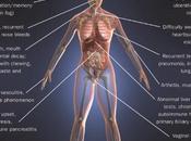 SYNDROME SJÖGREN L'infection bactérienne augmente risque EULAR