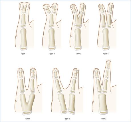 Syndactylie ou polydactylie ?