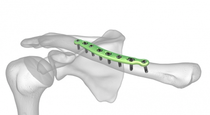 Fracture de la clavicule : comment ça se soigne ?