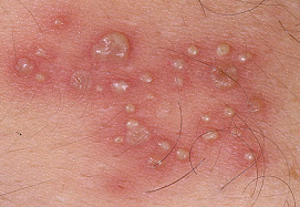 - Anda terkena penyakit herpes ??? bagaimana cara menyemb... Obat Herpes Alami