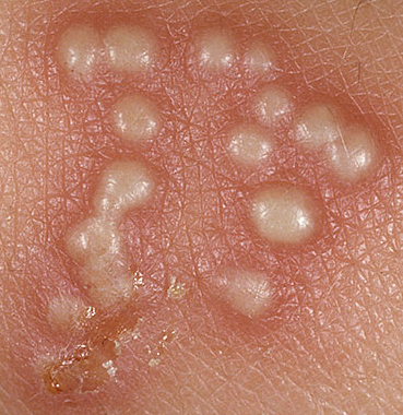 cara mengobati Herpes Obat Penyakit Herpes