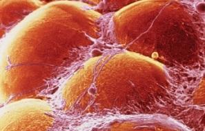 OBÉSITÉ et CANCER : Pourquoi la graisse viscérale est un accélérateur tumoral