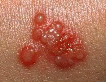 obat herpes buat balita Cara Mengatasi Herpes