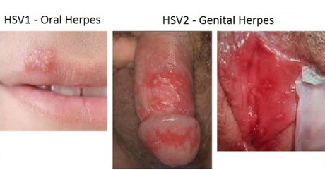 obat herpes basah Cara Mengobati Herpes