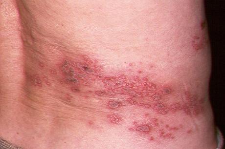 obat herpes balita Cara Menyembuhkan Herpes