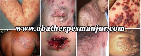 obat herpes buat bayi