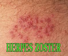 obat herpes salep