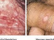 obat herpes alami untuk bayi