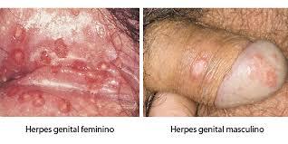 obat herpes alami