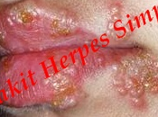 obat herpes antibiotik