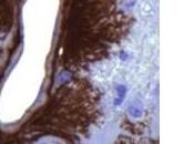 PARKINSON maladies PRIONS lien moléculaire contraire