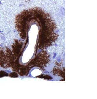 PARKINSON et maladies à PRIONS : Un lien moléculaire et contraire