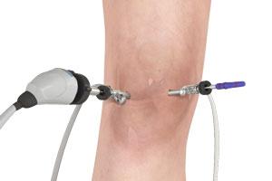 Intérêt du lavage articulaire dans l’arthrose du genou Intérêt du lavage articulaire dans l’arthrose du genou
