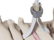 JAZZ LOCK implant cerclage innovateur dans chirurgie rachis