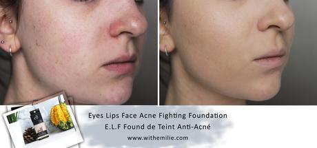 E.L.F fond de teint anti acné - Acne Fighting Foundation eyeslipsface (7) Before After