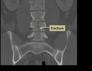 thelancet #femmepostménopausée #ostéoporose #fracture #teriparatide  #risedronate Effets du teriparatide et du risedronate chez les fractures  nouvellement apparues chez des femmes post-ménopausiques atteintes  d'ostéoporose sévère (VERO) : étude multice ...