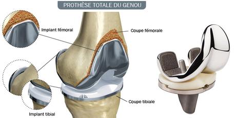 Arthrose du genou : quand faut-il penser à opérer ?