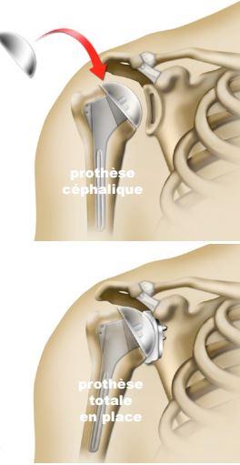 Traitement de l’arthrose de l’épaule par prothèse