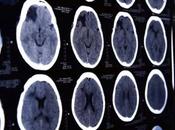 techniques spectaculaires restaurent flux sanguin vers cerveau