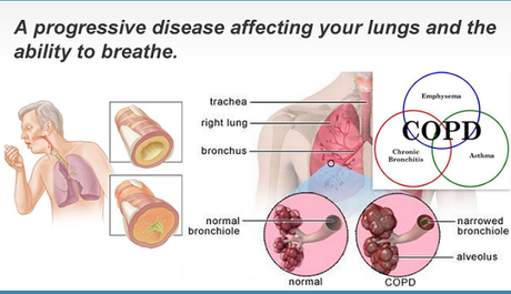 #thelancet #MPOC Trithérapie par inhalation versus double thérapie par bronchodilatateur dans la maladie pulmonaire obstructive chronique (TRIBUTE) : essai randomisé par groupes parallèles en double aveugle et contrôlé