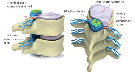 Infiltration foraminale pour soulager la douleur de l’hernie discale