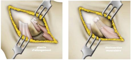 Épicondylite latérale : traitement médical et chirurgical