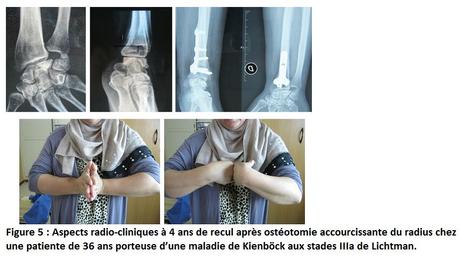 L’ostéotomie accourcissante du radius dans la maladie de Kienböck aux stades IIIa et IIIb de Lichtman.