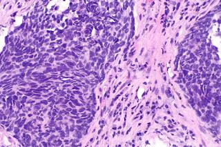 #thelancetoncology #CBNPC #durvalumab Durvalumab comme traitement de troisième ligne ou postérieur pour le traitement du cancer du poumon non à petites cellules (ATLANTIC) : étude ouverte à simple bras de phase 2