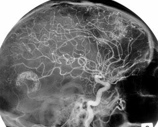#thelancetoncology #mélanome #métastasescérébrales #nivolumab #ipilimumab Cocktail nivolumab + ipilimumab ou nivolumab seul pour le traitement des métastases cérébrales : essai multicentrique randomisé de phase 2 #thelancetoncology #mélanome #métastasescérébrales #nivolumab #ipilimumab Cocktail nivolumab + ipilimumab ou nivolumab seul pour le traitement des métastases cérébrales : essai multicentrique randomisé de phase 2